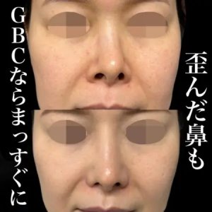 Before - 『鼻中隔湾曲修正』＋『鼻骨削り』＋『プロテーゼ』＋『鼻尖形成』＋『軟骨移植』＋『鼻翼縮小』＋『鼻柱下降』