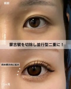 After - 『目頭切開』＋『埋没二重』
