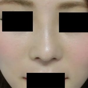 After - 『GBCソフトプロテーゼ隆鼻術』＋『鼻尖形成術』＋『鼻尖部軟骨移植』