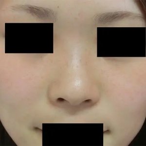 Before - 『GBCソフトプロテーゼ隆鼻術』＋『鼻尖形成術』＋『鼻尖部軟骨移植』