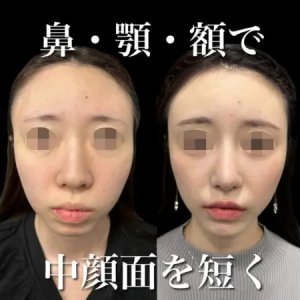 Before - 『わし鼻修正』＋『プロテーゼ』＋『鼻尖形成』＋『軟骨移植』＋『鼻柱下降』＋『鼻翼縮小』＋『あごプロテーゼ』＋『額・こめかみ脂肪注入』