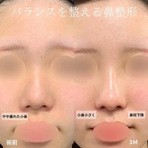After - 『鼻尖形成』＋『軟骨移植』＋『鼻翼縮小』＋『鼻柱下降』
