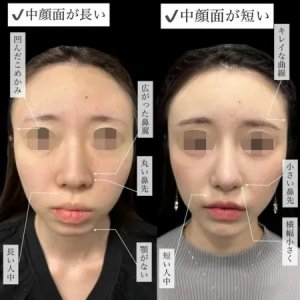 After - 『わし鼻修正』＋『プロテーゼ』＋『鼻尖形成』＋『軟骨移植』＋『鼻柱下降』＋『鼻翼縮小』＋『あごプロテーゼ』＋『額・こめかみ脂肪注入』