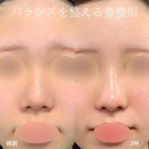 Before - 『鼻尖形成』＋『軟骨移植』＋『鼻翼縮小』＋『鼻柱下降』