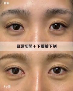 Before - 『目頭切開』＋『下眼瞼下制』