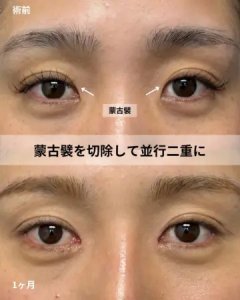 After - 『目頭切開』＋『下眼瞼下制』