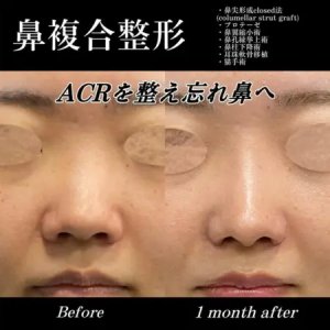 Before - 『鼻尖形成』＋『プロテーゼ』＋『鼻翼縮小』＋『鼻孔縁挙上』＋『鼻柱下降』＋『軟骨移植』＋『猫手術』
