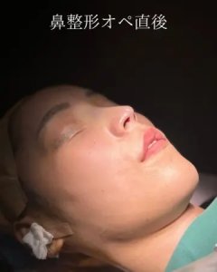 After - 『鼻尖形成』＋『軟骨移植』