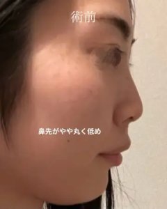 Before - 『鼻尖形成』＋『軟骨移植』
