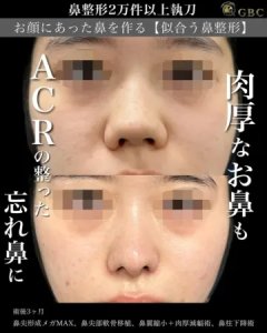 Before - 『鼻尖形成』＋『鼻翼縮小』＋『軟骨移植』＋『肉厚減幅』＋『鼻柱下降』