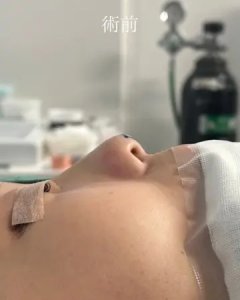 Before - 『鼻尖形成』＋『軟骨移植』