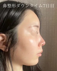 After - 『鼻尖形成』＋『軟骨移植』
