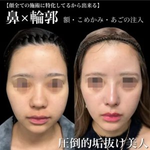 Before - 『プロテーゼ』＋『鼻尖形成』＋『軟骨移植』＋『鼻柱下降』 ＋『鼻翼縮小』＋『あごヒアルロン酸』＋『額・こめかみ脂肪注入』
