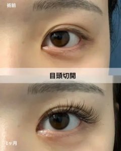 Before - 『GBC式目頭切開』