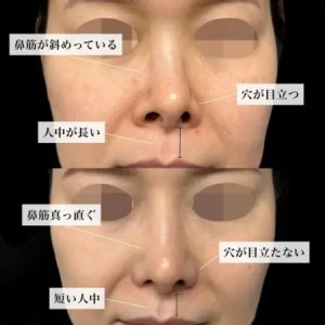 After - 『鼻中隔湾曲修正』＋『鼻骨削り』＋『プロテーゼ』＋『鼻尖形成』＋『軟骨移植』＋『鼻翼縮小』＋『鼻柱下降』