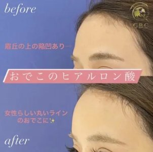 Before - 額のヒアルロン酸