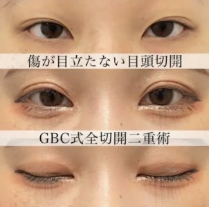 Before - 『全切開二重術 』＋『GBC式目頭切開』