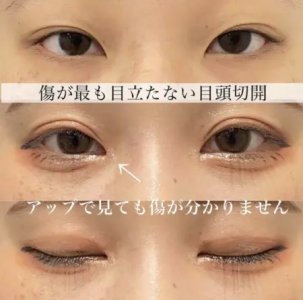 After - 『全切開二重術 』＋『GBC式目頭切開』