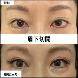 Before - 『 眉下切開 』