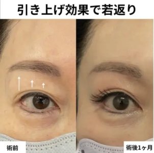 After - 『 眉下切開 』