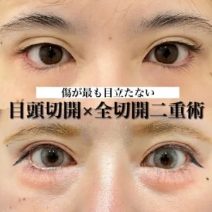 Before - 『たるみ取り併用全切開二重術』＋『GBC式目頭切開』