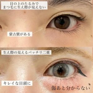 After - 『たるみ取り併用全切開二重術』＋『GBC式目頭切開』