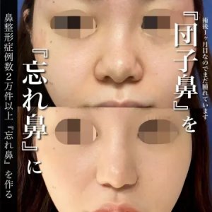 Before - 『GBCソフトプロテーゼ隆鼻術』＋『鼻尖形成術』＋『鼻尖部軟骨移植』＋『鼻翼縮小術 』＋『切らない小鼻縮小術』＋『⾁厚減幅術』