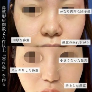 After - 『GBCソフトプロテーゼ隆鼻術』＋『鼻尖形成術』＋『鼻尖部軟骨移植』＋『鼻翼縮小術 』＋『切らない小鼻縮小術』＋『⾁厚減幅術』
