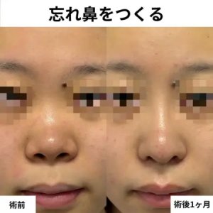 Before - 『鼻尖形成 』＋『鼻中隔延長』＋『鼻柱下降』＋『鼻翼縮小(内外) 』＋『プロテーゼ』