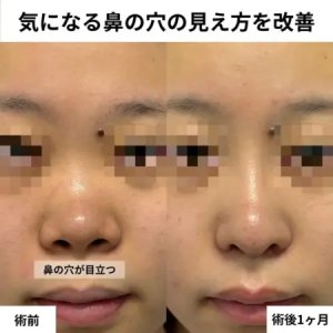After - 『鼻尖形成 』＋『鼻中隔延長』＋『鼻柱下降』＋『鼻翼縮小(内外) 』＋『プロテーゼ』