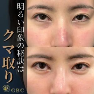 Before - 『目の下の切らないたるみ取り 』＋『シルキーファット注入』