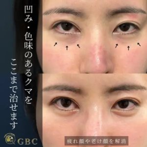 After - 『目の下の切らないたるみ取り 』＋『シルキーファット注入』