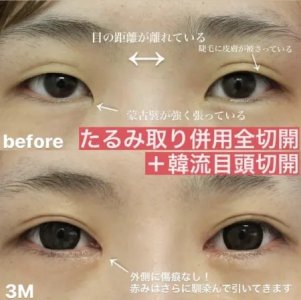 Before - 『たるみ取り併用全切開二重術 』＋『韓流目頭切開』