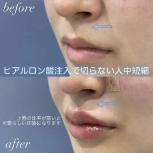 Before - ヒアルロン酸＋人中短縮