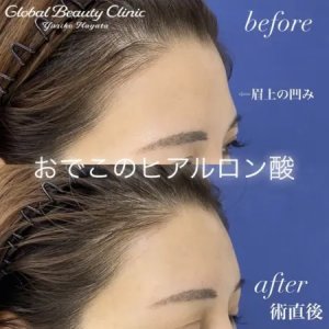 Before - 額のヒアルロン酸『 ボリューマ3cc』