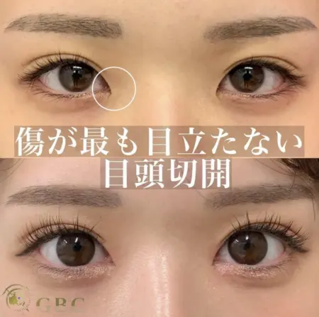 After - 『目頭切開』