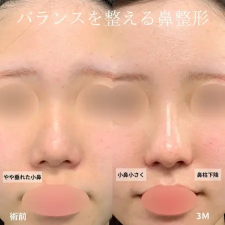 After - バランスを整える鼻整形