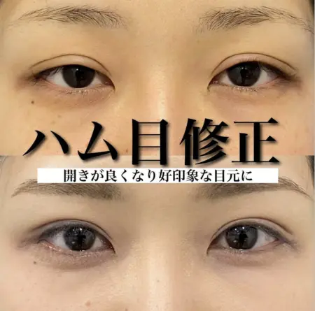 Before - 『上眼瞼たるみ取り』