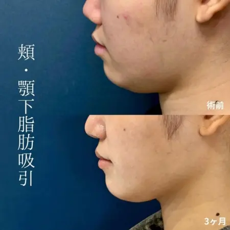 Before - 頬・顎下脂肪吸引で美しいフェイスラインに 
