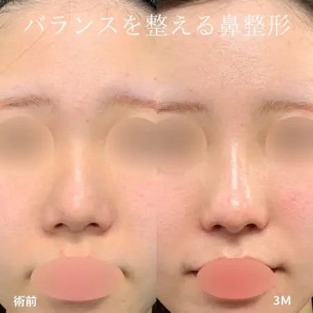Before - バランスを整える鼻整形