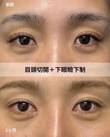 Before - 『目頭切開』＋『下眼瞼下制』