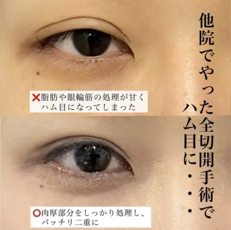 After - 『上眼瞼たるみ取り』