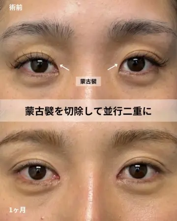 After - 『目頭切開』＋『下眼瞼下制』