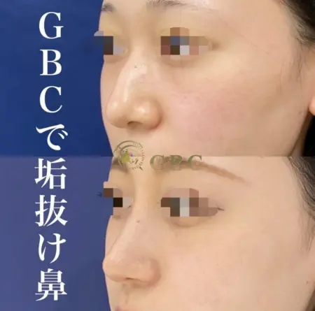 After - 『わし鼻修正』＋『プロテーゼ』＋『鼻尖形成』＋『鼻尖部軟骨移植』＋『鼻翼縮小』