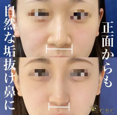 Before - 『わし鼻修正』＋『プロテーゼ』＋『鼻尖形成』＋『鼻尖部軟骨移植』＋『鼻翼縮小』