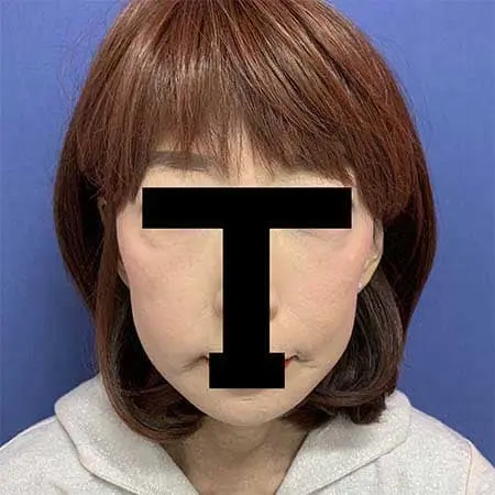 After - 大手美容外科時代若返り施術件数Ｎｏ．１の院長直伝！確かなリフトアップ・小顔効果！『 ＧＢＣフェイスリフト 』