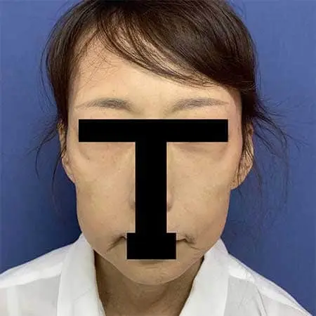 Before - 大手美容外科時代若返り施術件数Ｎｏ．１の院長直伝！確かなリフトアップ・小顔効果！『 ＧＢＣフェイスリフト 』