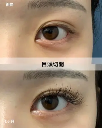 Before - 『GBC式目頭切開』