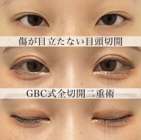 Before - 『全切開二重術 』＋『GBC式目頭切開』