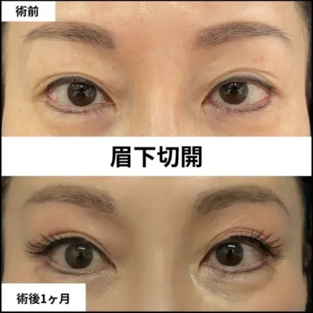 Before - 『 眉下切開 』